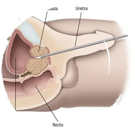 Resección transuretral de la próstata (RTUP)
