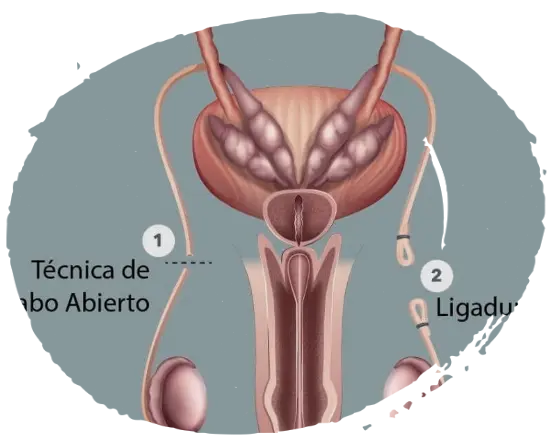 Vasectomía Vasectomía